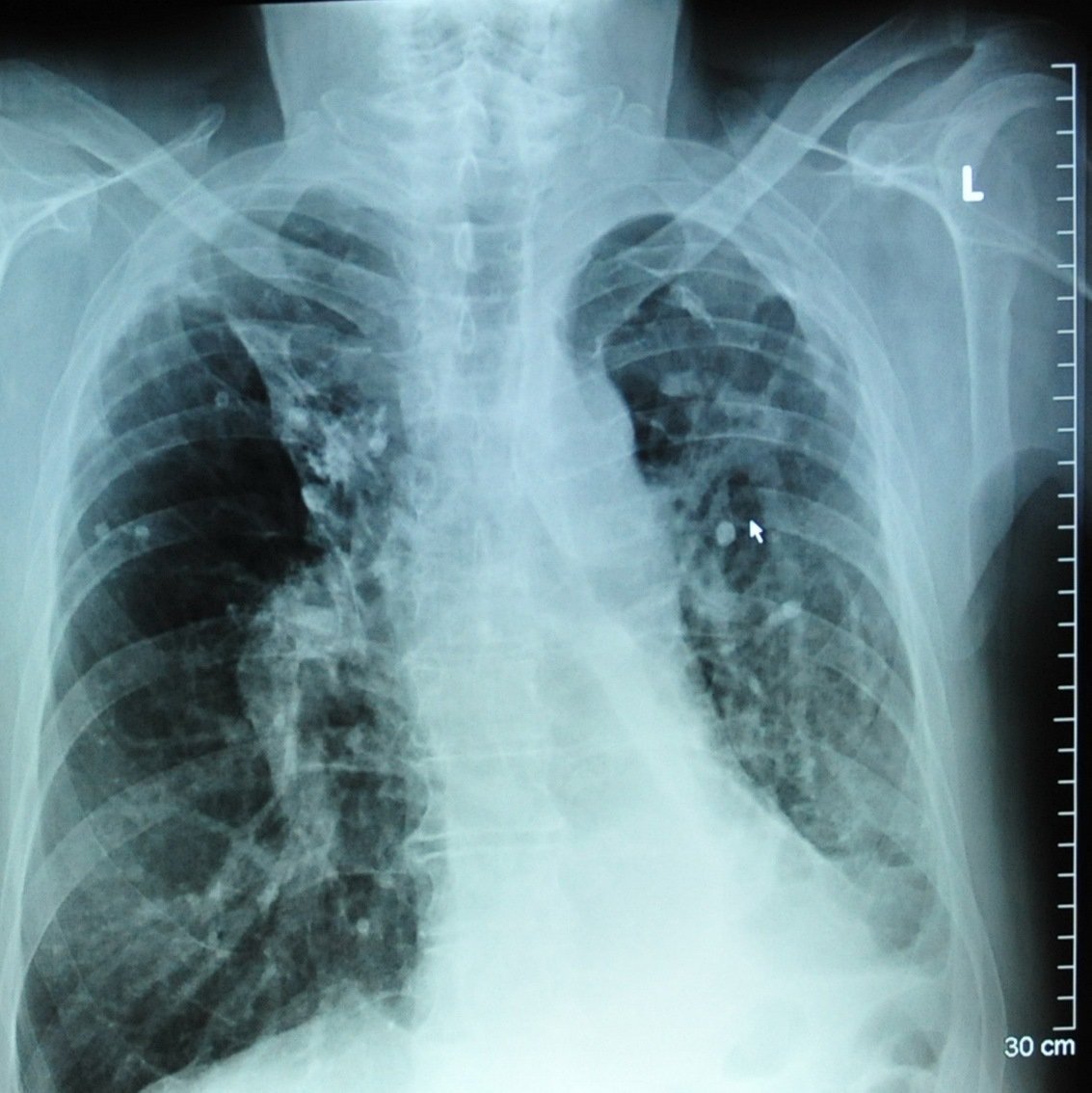 You are currently viewing Pažaboti tuberkuliozei siūlomas ir priverstinis gydymas